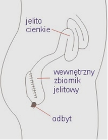 Zastosowanie j-pouch – zachowanie ciągłości układu pokarmowego po wycięciu jelita grubego (WZJG)